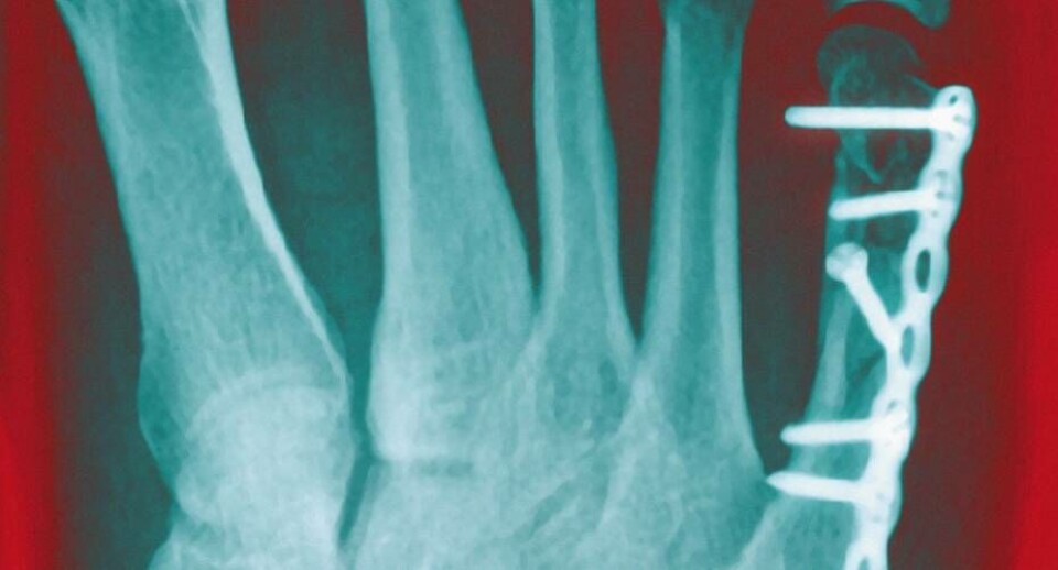 Implantater invaderes af bakterier og svampe