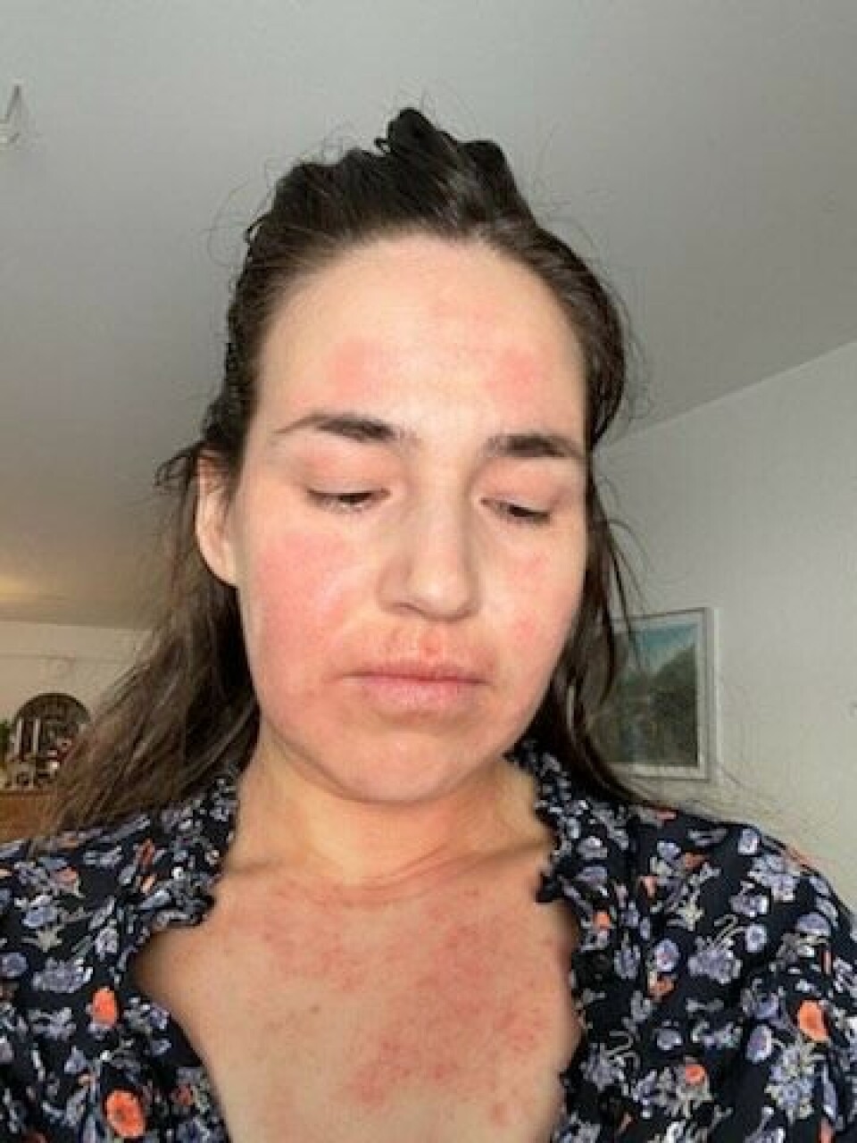 – Jeg har haft tilbagevendende stafylokokker,siden jeg stoppede med penicillin for 14dage siden, og der er kommet udslæt igen.Det har været hårdt, fordi jeg stadig ammermin datter, og det kan jeg ikke, når jeg er påpencillin, fortæller Malu Petrussen til Sermitsiaq.