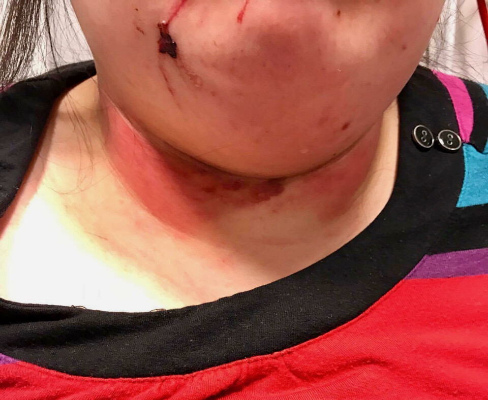 Som det ses af billedet blev kvinden udsat for grov vold natten til onsdag. kvinde overfaldet