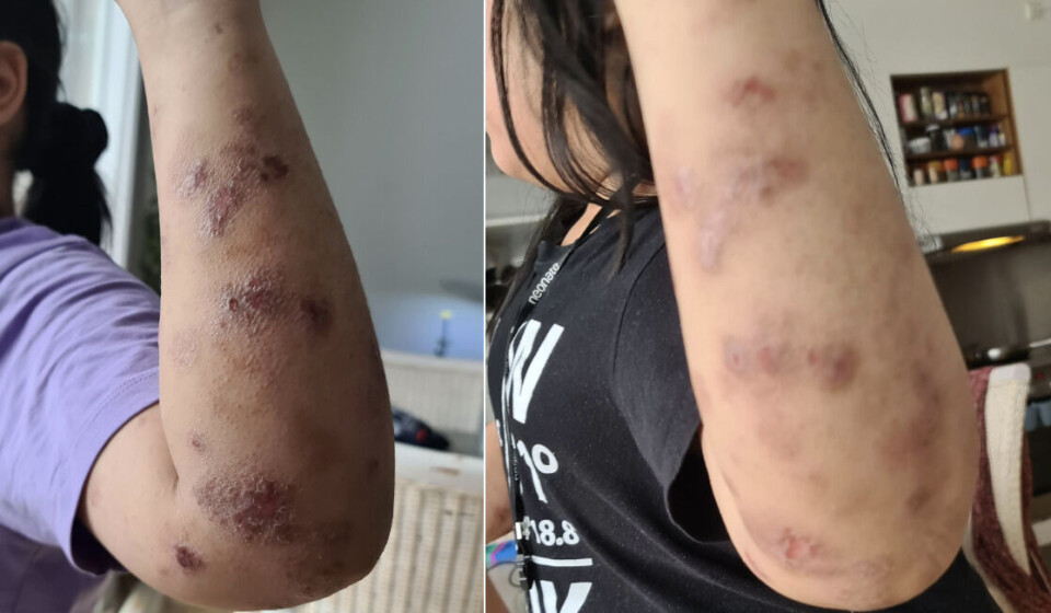 Et før og efterbillede af 11-årige Angelicas arme, der langsomt, men sikkert er begyndt af hele.